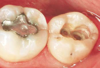 Tilståelse Bror Dræbte Revner i tænderne - dentininfraktioner - Tandlægeforeningen
