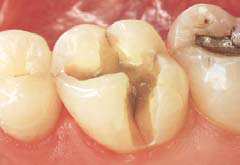 Rodbehandlet tand gør ondt