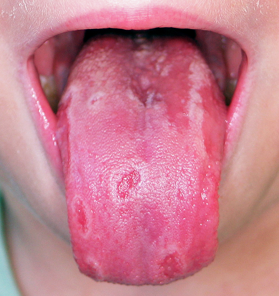 Herpes i munden