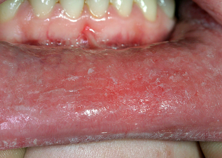 Candida svamp i munden