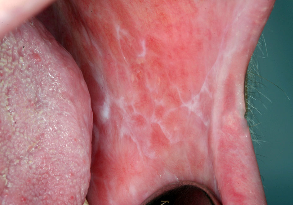 Kræft i munden symptomer