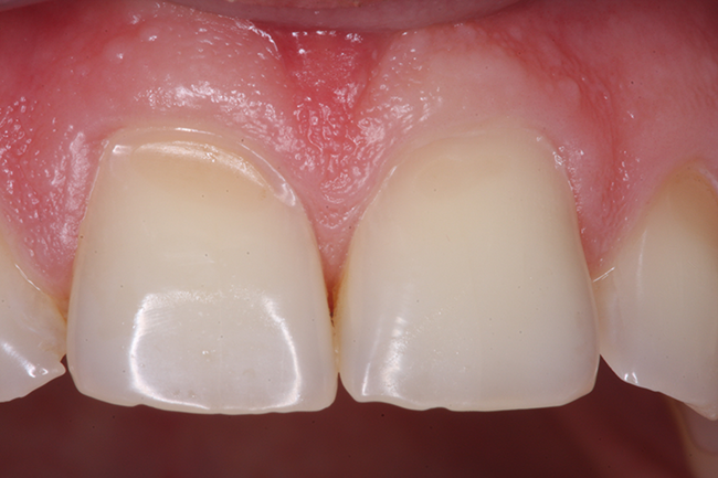 fløjte Dalset progressiv Erosioner – syreskader på tænderne - Tandlægeforeningen