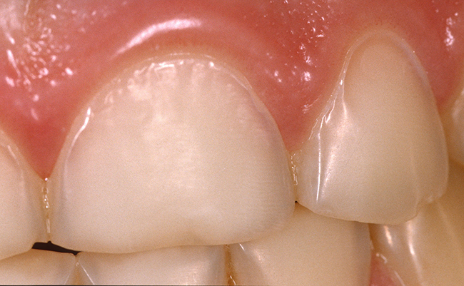fløjte Dalset progressiv Erosioner – syreskader på tænderne - Tandlægeforeningen